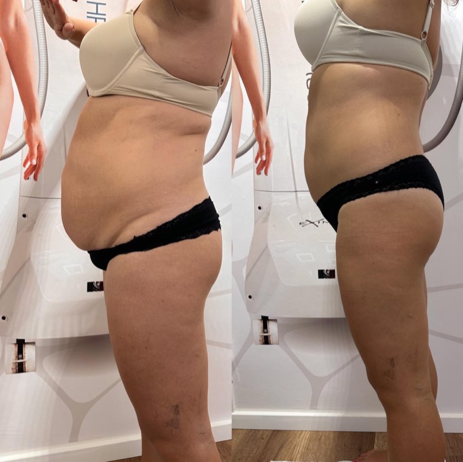 Comparatie before si after, profil si abdomen