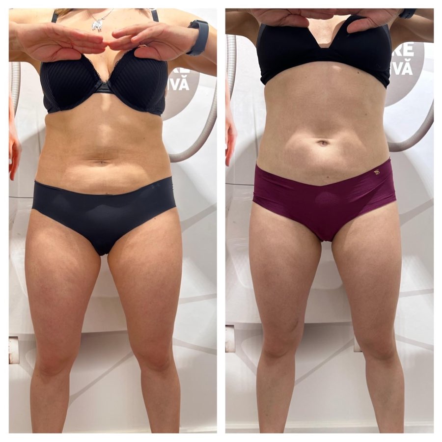 Comparatie before si after, vedere frontala