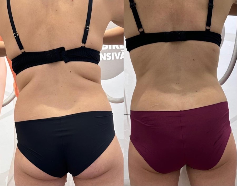 Comparatie before si after, zona spatelui