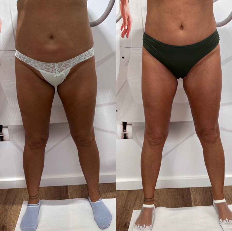 Comparatie before si after, vedere frontala a abdomenului si coapselor
