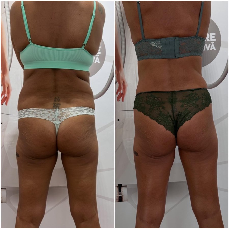 Comparatie before si after, vedere posterioara