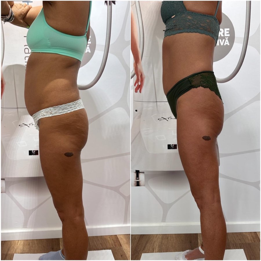 Comparatie before si after, profil al abdomenului si coapselor